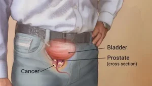 Measures of preventing Prostate Cancer